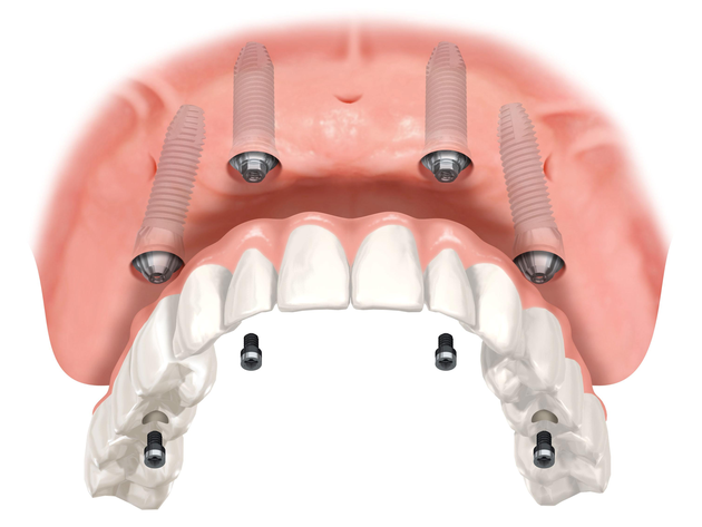 Brillantino sul dente - Studio Dentistico Dott. Giulio Ruggieri