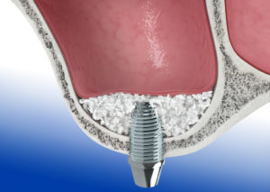 Augmentation-with-Geistlich-Bio-Oss-and-Implant-insertion